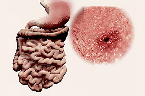 Gastric bleeding