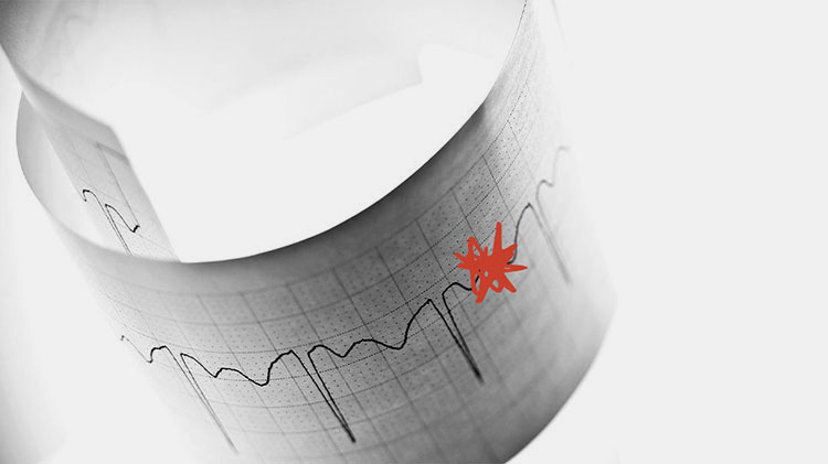Heart rhythm problems