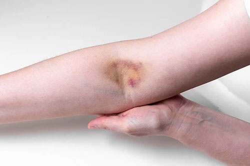 Inflammation at injection
