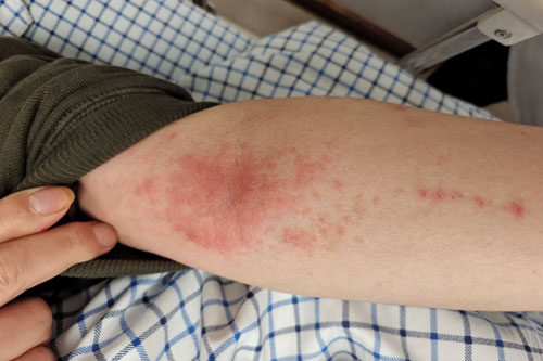 Injection site