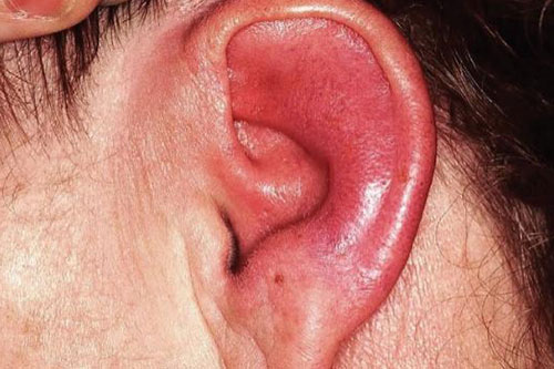 Itching or redness in the ear