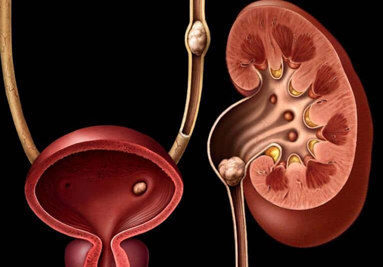 Kidney stones