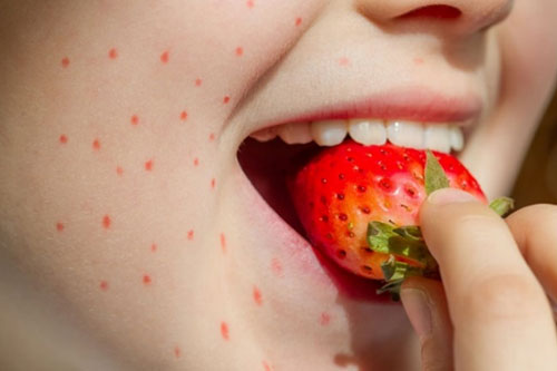 Mild Food or Drug Reactions