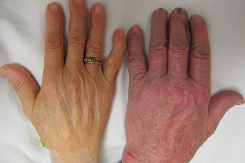 People with severe anemia