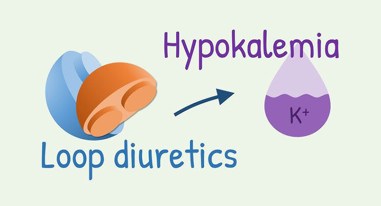 Potassium loss due to diuretics