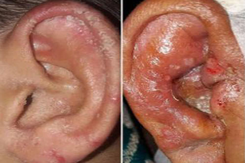 Sterile Use Ear Drops