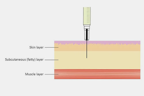 Subcutaneous injection