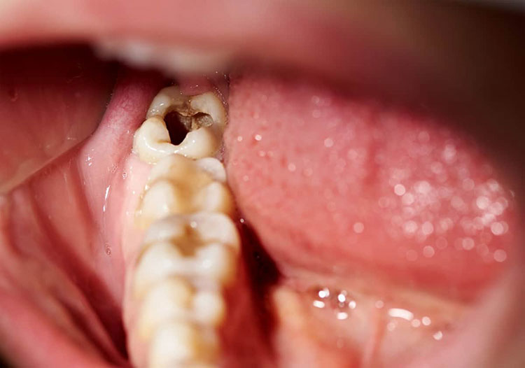 Tooth or gum infection