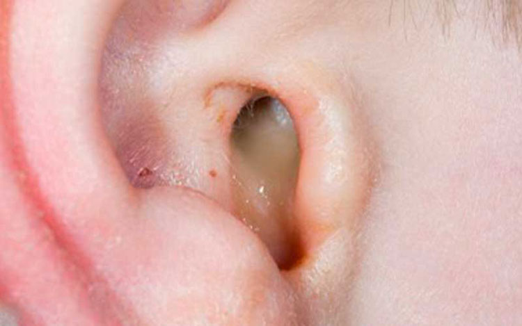 Treat ear infection