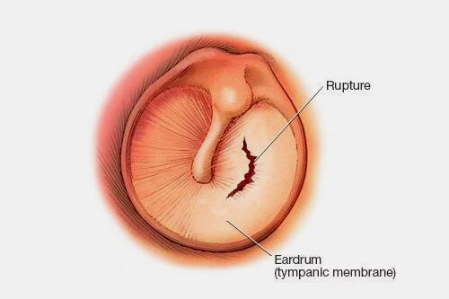Using ear drops with a ruptured ear drum