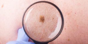 Chemotherapy Drugs for Metastatic Melanoma